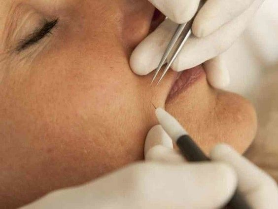 Electrolysis hair removal treatment being performed on the face